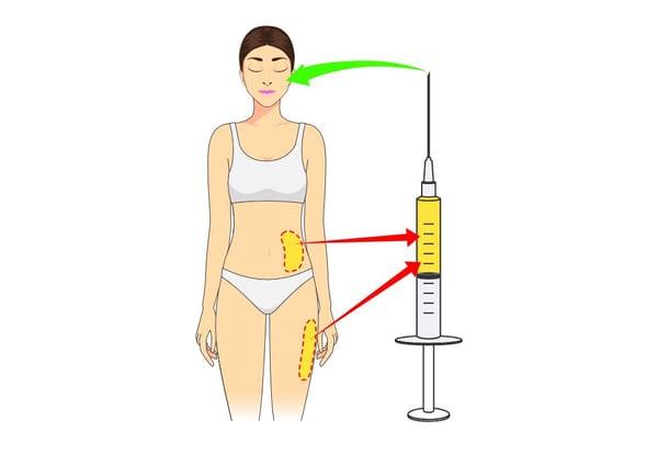fat transfer to face