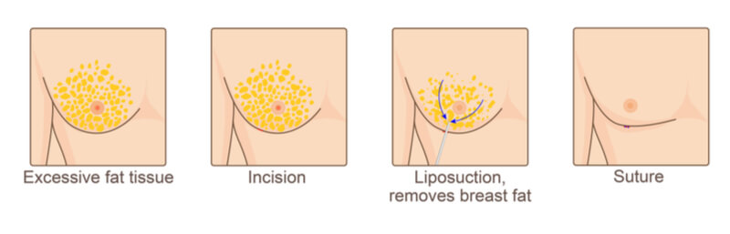 gynecomastia liposuction surgery