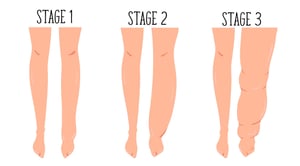 isl lymphedema stages