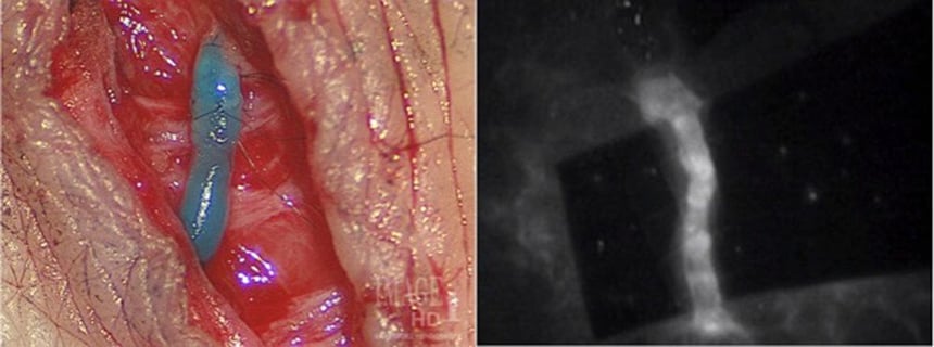 lymphovenous bypass-wiley