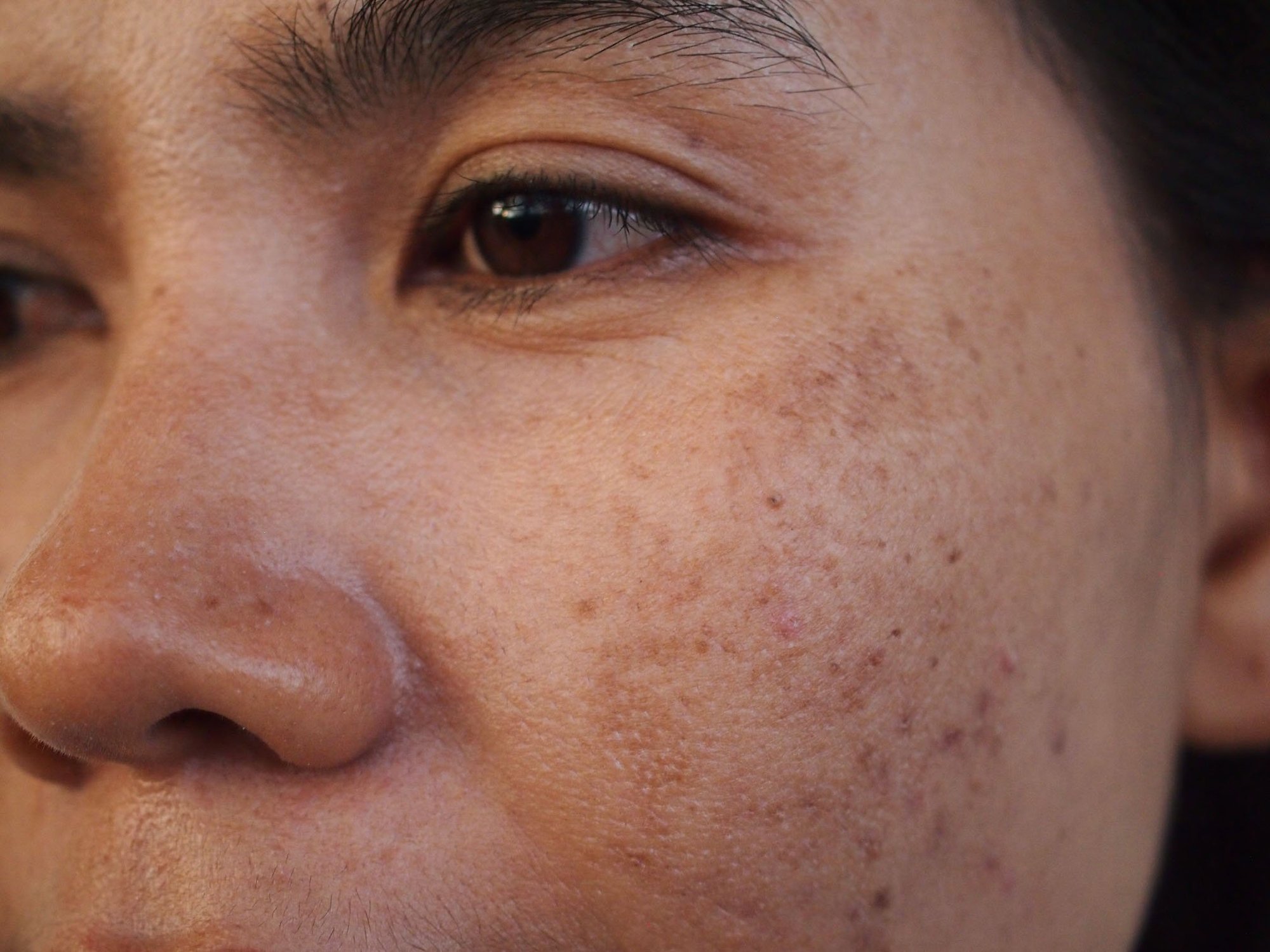 Close up of Pigmentation on a woman's face