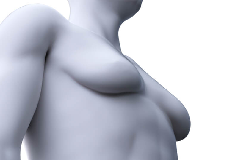 ptosis gynecomastia breast surgery
