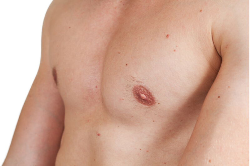 recovery process after male breast reduction