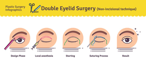 scarless-Double-Eyelid-creation