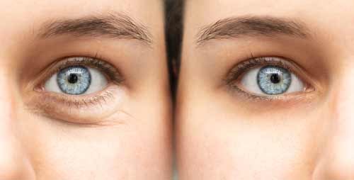 lower-eyelid-surgery-and-eyebag-removal