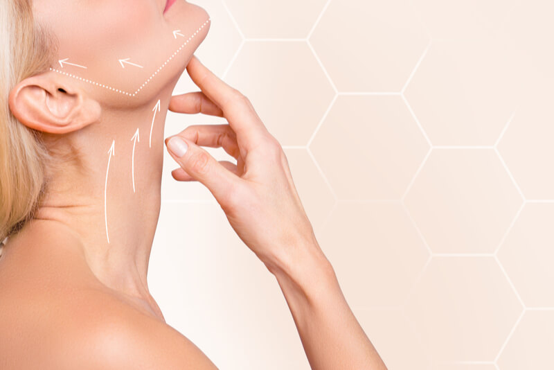 smas facelift technique