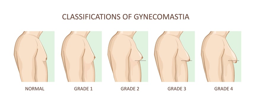 stages of gynecomastia