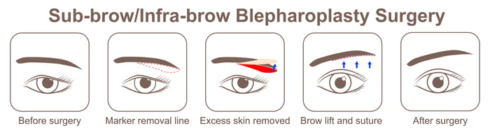 sub-brow blepharoplasty-2