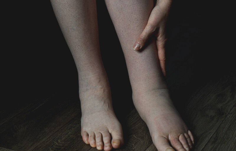 Lymphedema Surgery