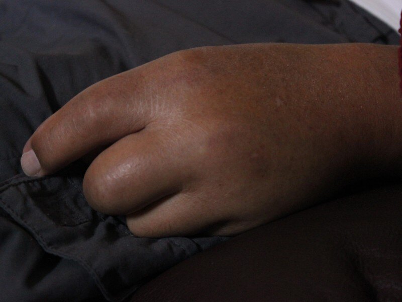 Lymphedema Surgery