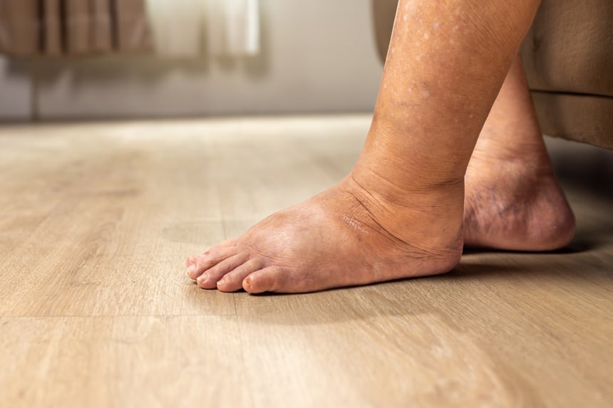 Lymphedema on the legs and feet