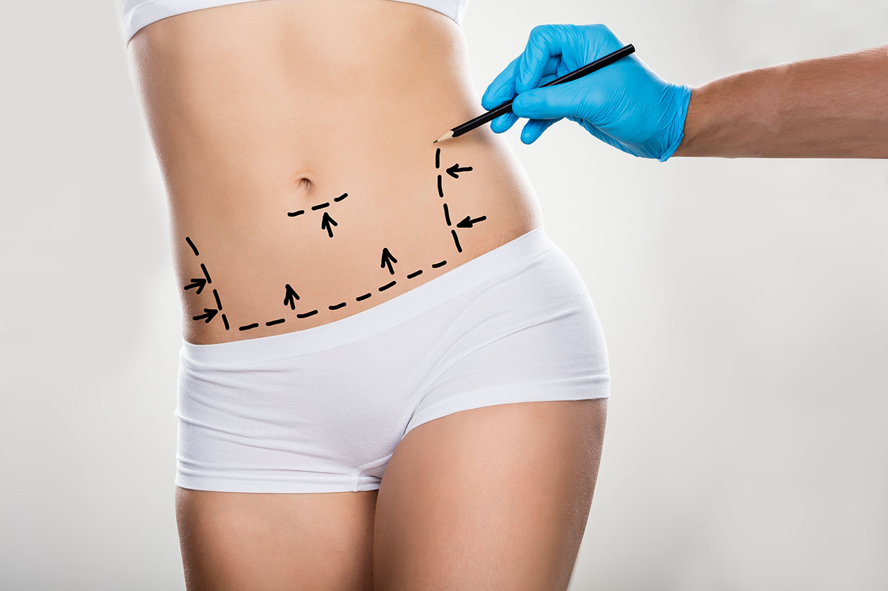 Mini abdominoplasty