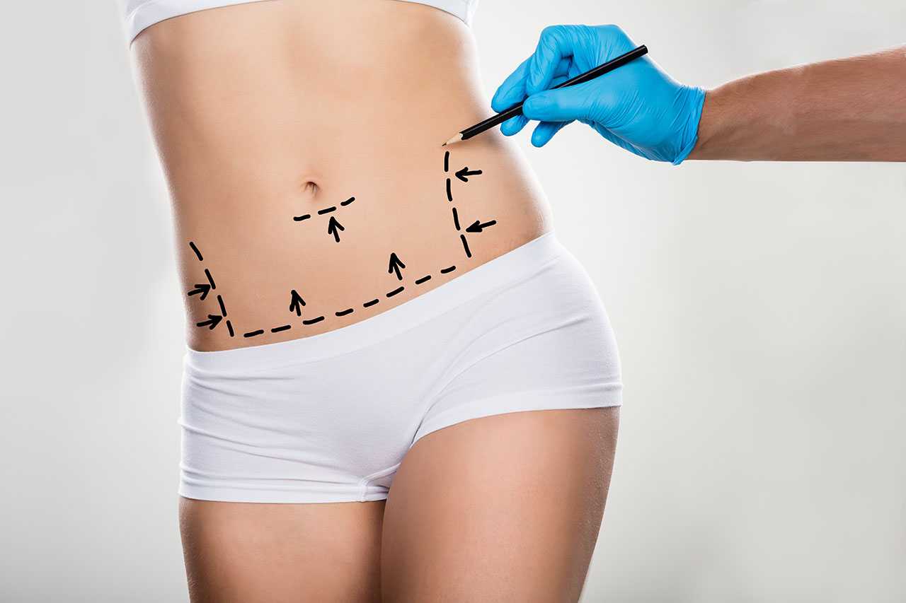 Mini abdominoplasty Mini abdominoplasty
