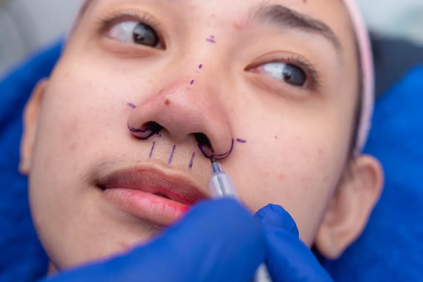 Patient getting a rhinoplasty in Singapore