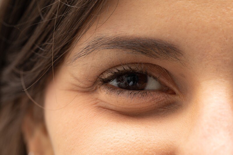 Scarless Eyebag Removal