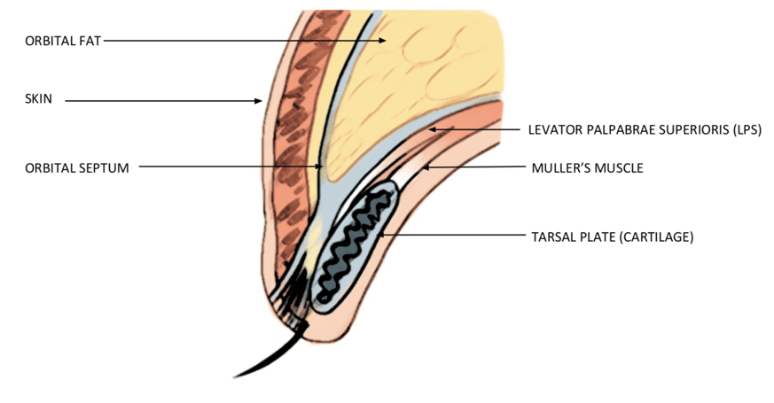 eyelid and brow surgery