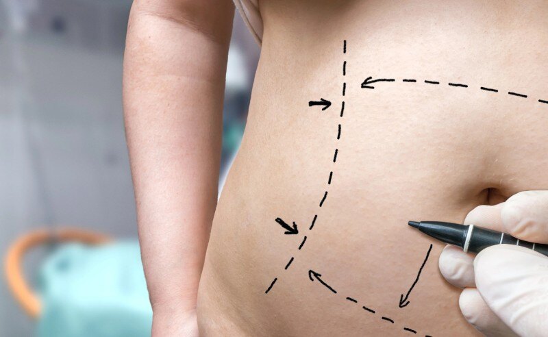 Tummy Tuck
