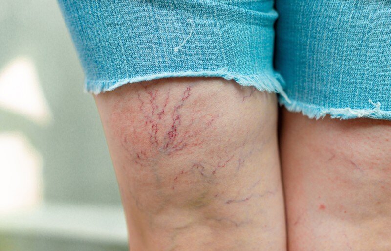 Vessels Extremity