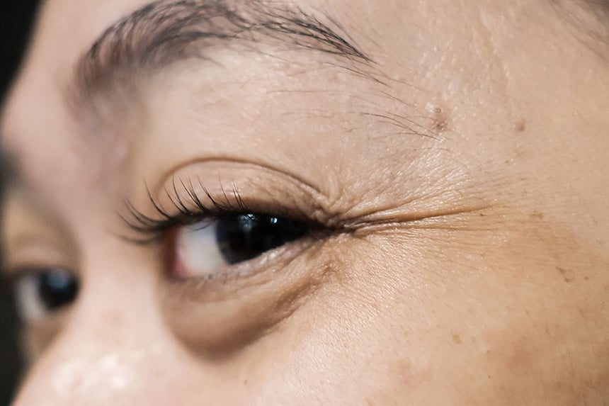 Woman with eye bags