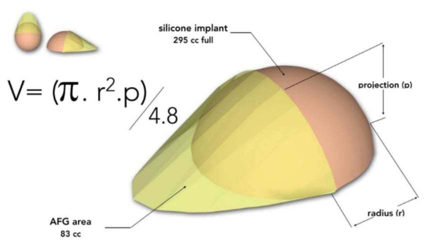 breast implant