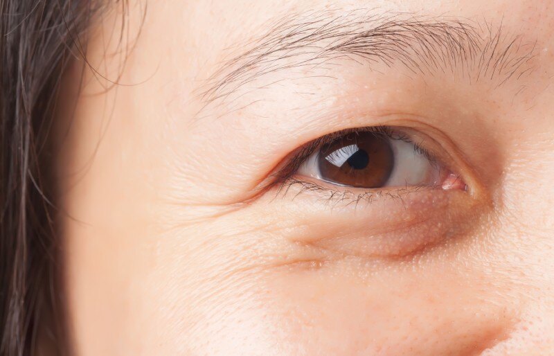 Dermatochalasis Removal