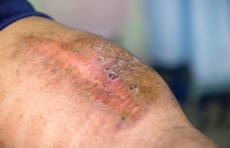 Extremity Trauma