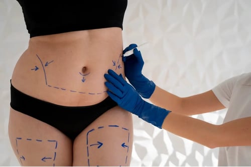 liposuction-bpdy-tummy