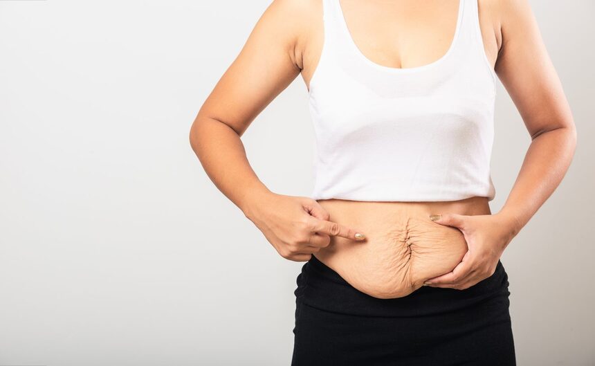 Shot of post-pregnancy stretch marks