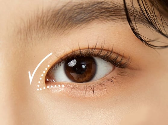 Tapered eyelid surgery outlet