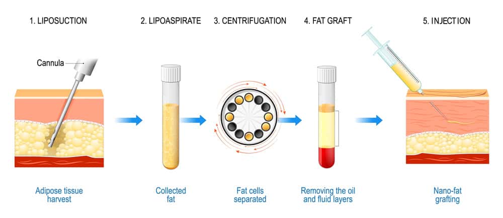 fat_grafting_process