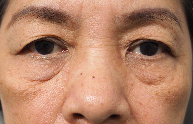 sub-brow blepharoplasty