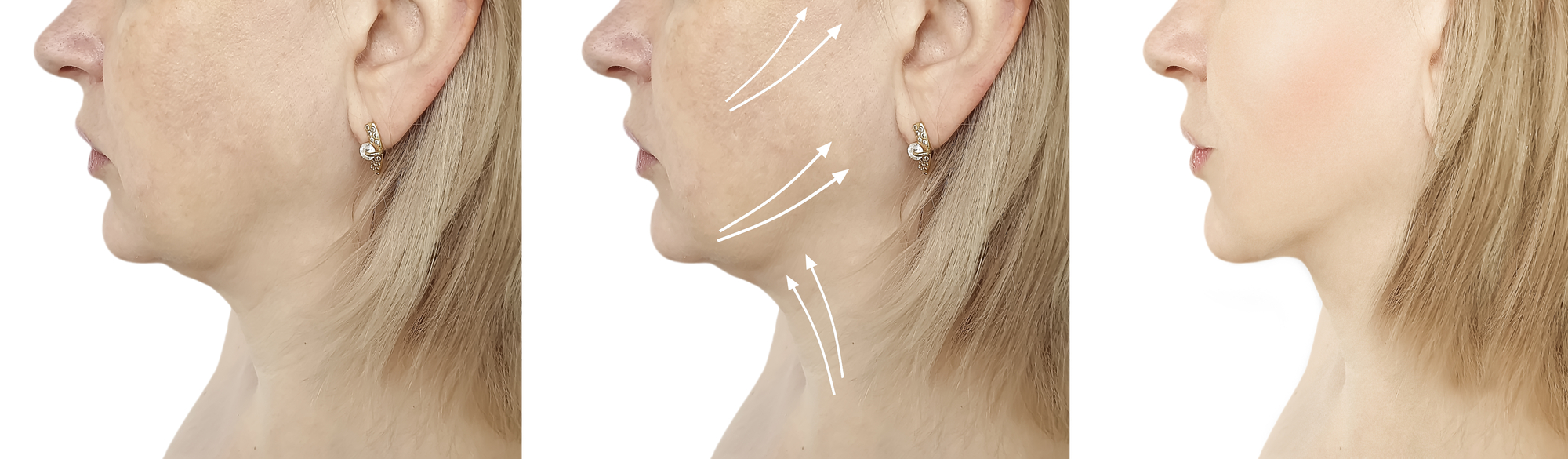 facelift_chin_neck