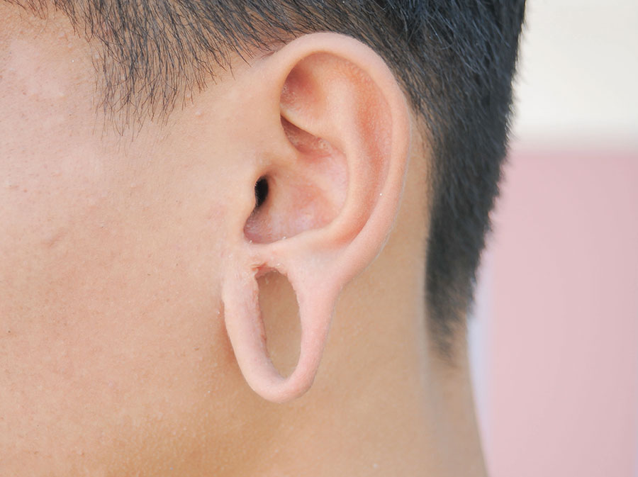 Ear Lobe Repair