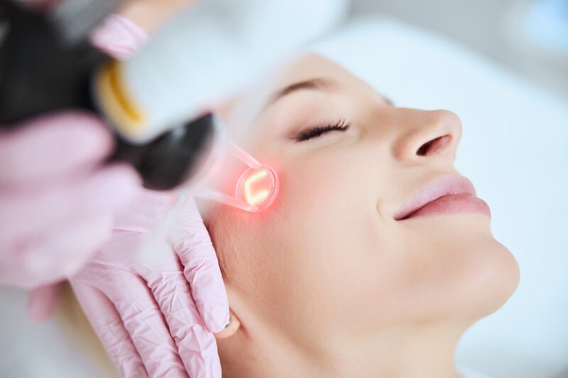 Fractional Laser resurfacing