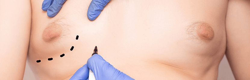 Gynecomastia 1