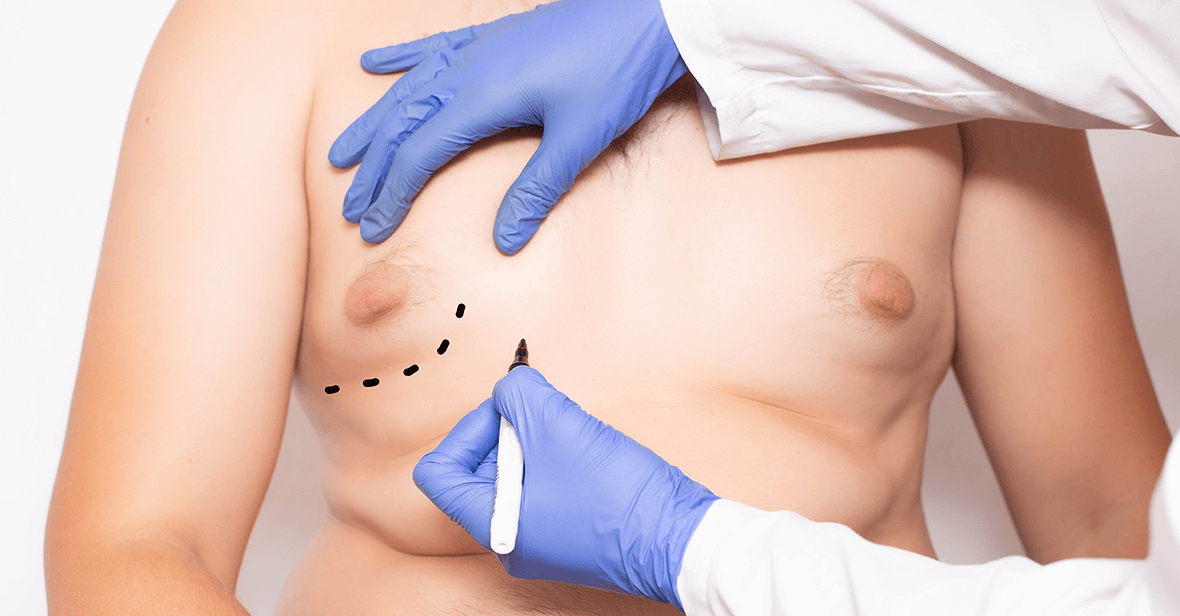 Gynecomastia Anchor