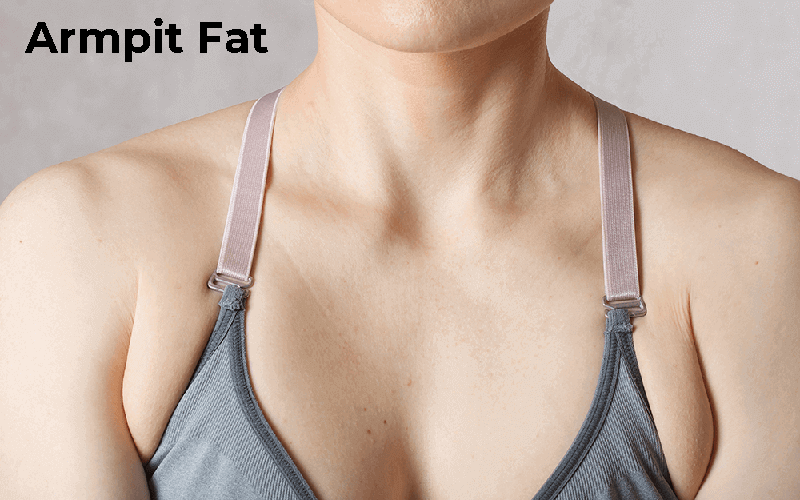 ONFA_Lipo-armpit-fat-2-1