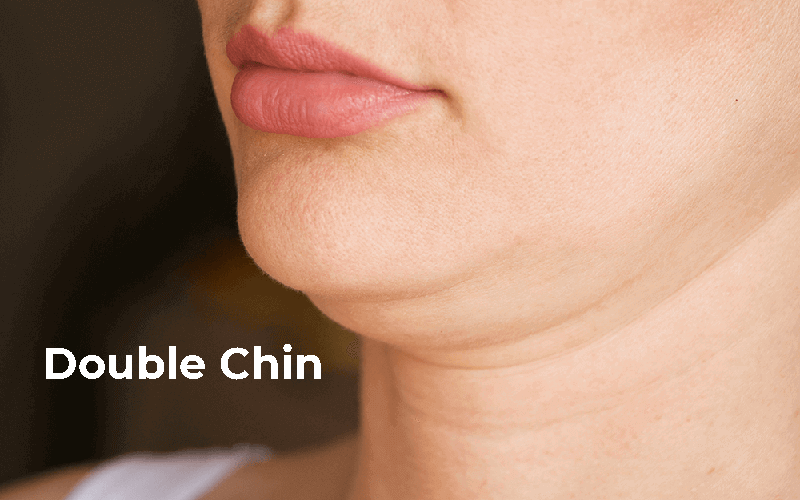 ONFA_Lipo-double-chin-1