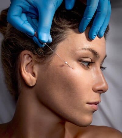 Threadlift