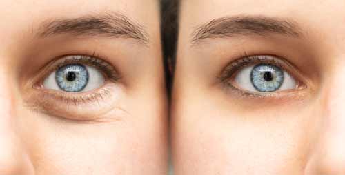 scarless-eyebag-removal