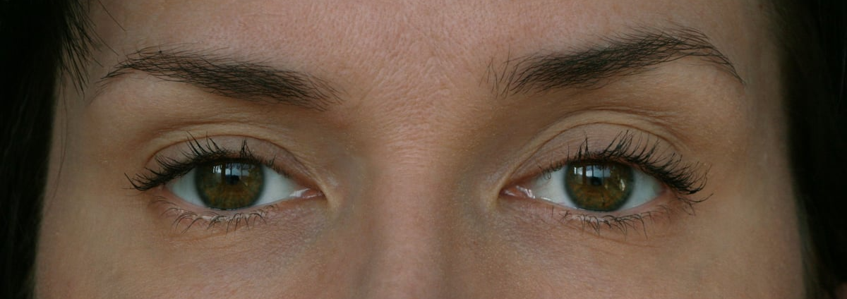 Ptosis 1