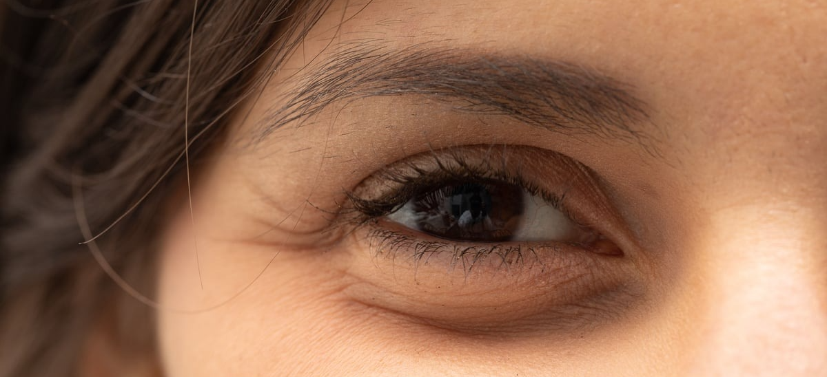 Scarless Eyebag Removal